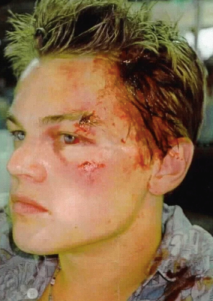 At a party in 2005, he was hit by a woman with a wine glass.