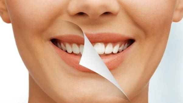 Teeth Whitening Techniques