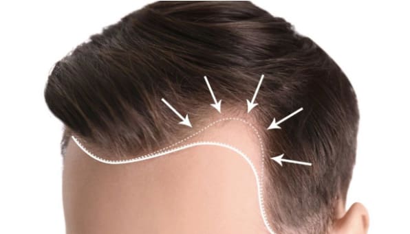 Thicker Hair in a Short Time (Natural Methods)