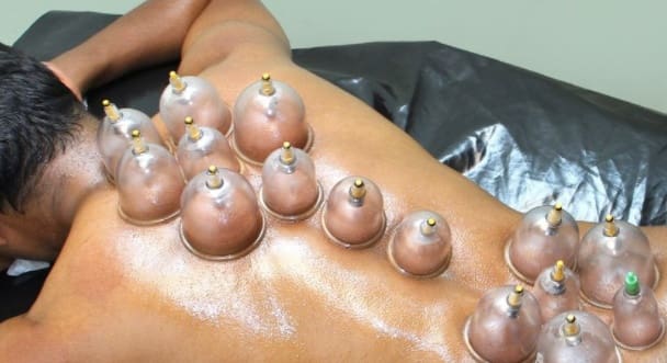 Wha is Hijama – Wet cupping or Hacamat?