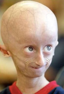 Progeria Disease