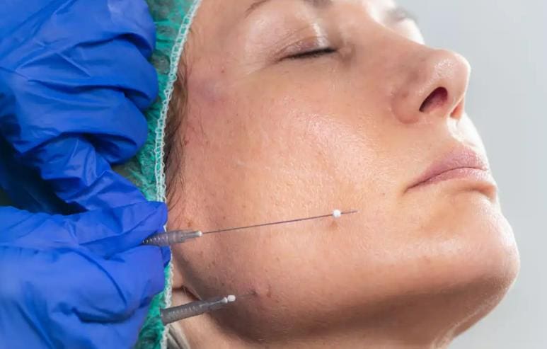 How is a Non-Surgical Thread Facelift Performed?